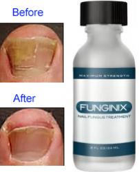 Toenail Fungus Results with Funginix