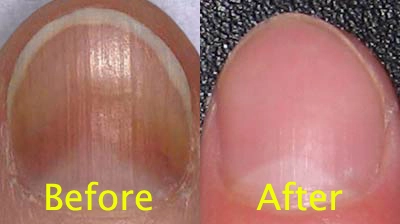 Before and After Nail Fungus Treatment